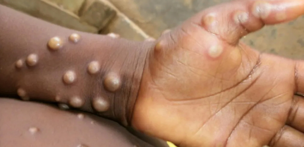 Mpox au Cameroun: 5 cas confirmés